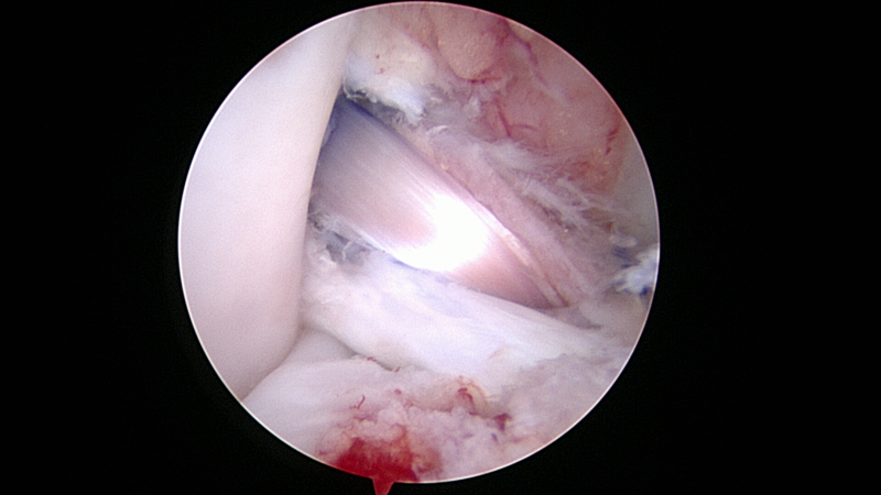 Arthroscopic view of ACL reconstruction technique in a dog