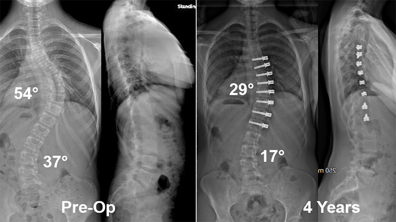 vertebral body tethering scoliosis treatment x-ray