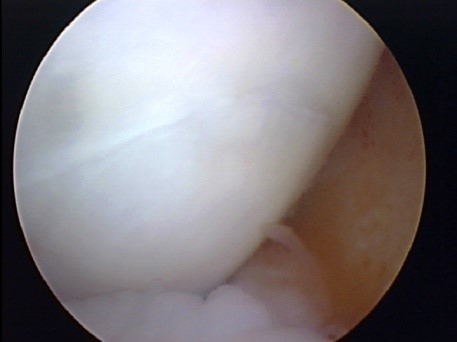 Arthroscopic image showing a Mizzou System OCA graft implanted into a dog’s knee to treat a cartilage defect