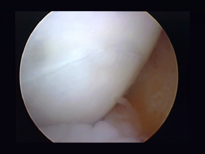 Arthroscopic image showing a Mizzou System OCA graft implanted into a dog’s knee to treat a cartilage defect