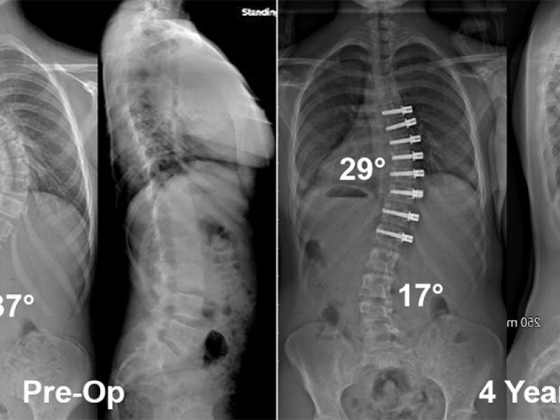 vertebral body tethering scoliosis treatment x-ray